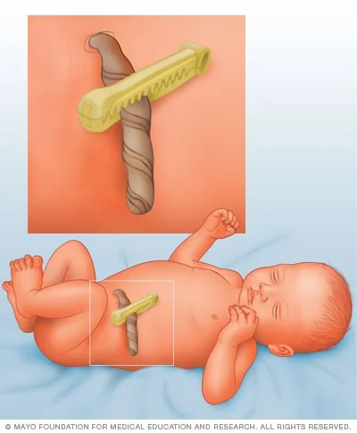 Cordon ombilical clampé juste après la naissance