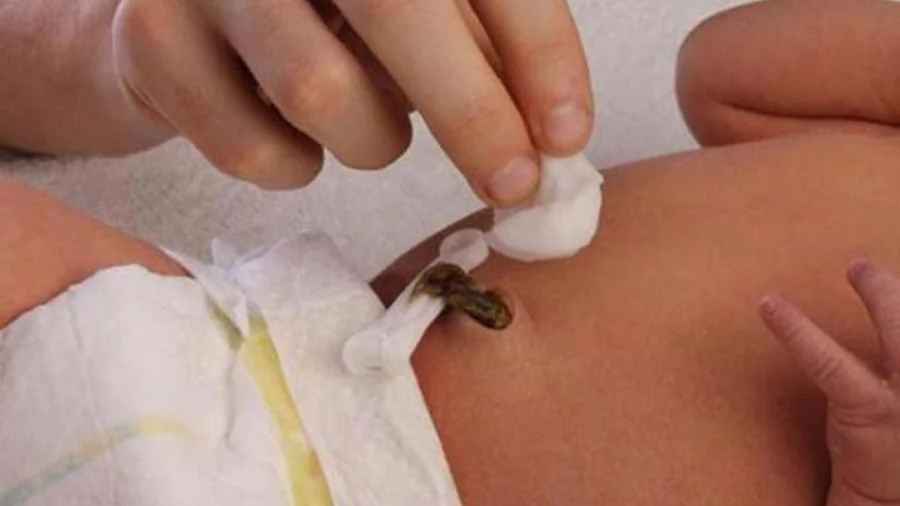 Aspect d'un moignon de cordon ombilical en train de sécher sur le ventre d'un bébé.