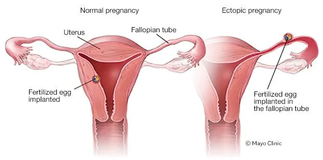 Schéma médical comparant une grossesse normale dans l'utérus et une grossesse extra-utérine dans la trompe de Fallope