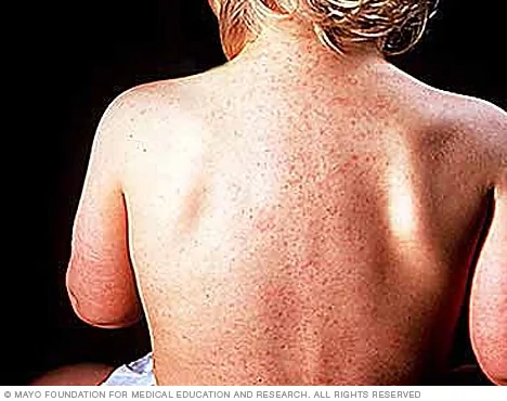 Éruption cutanée typique de la roséole avec de petites taches rosées sur le torse d'un bébé