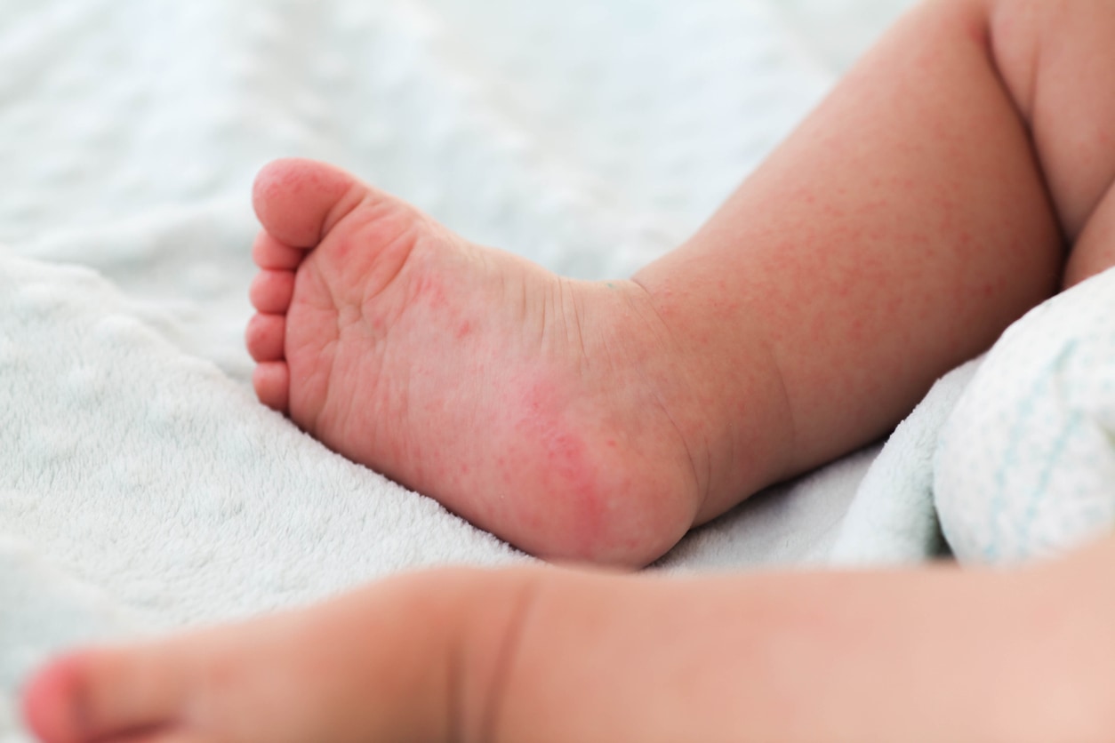 Éruption cutanée sur la jambe d'un enfant