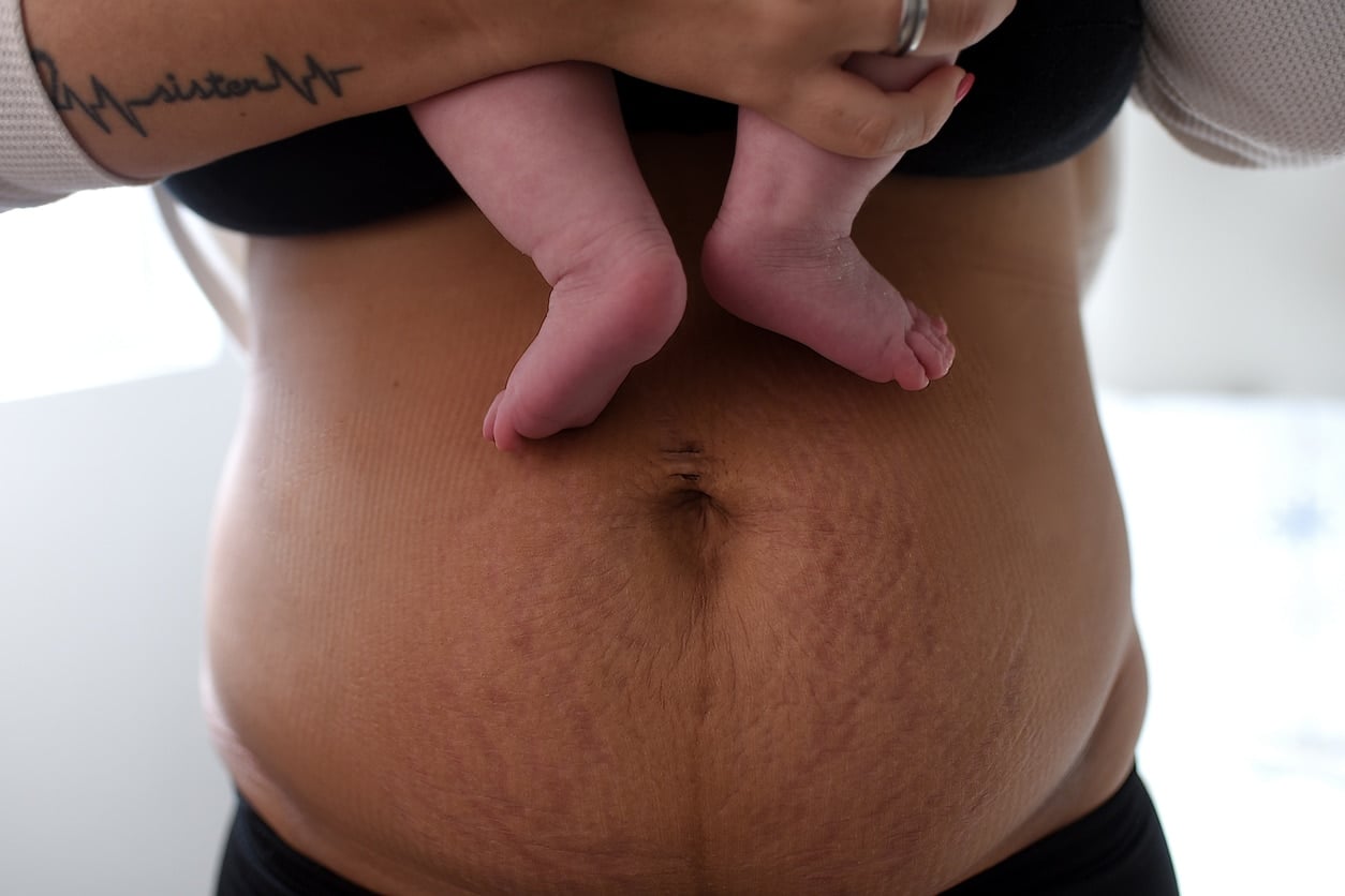 Vergetures sur un ventre post-partum