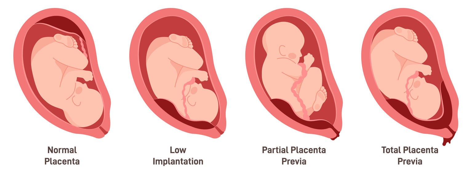 Schéma des différentes positions du placenta : praevia, total, bas et partiel