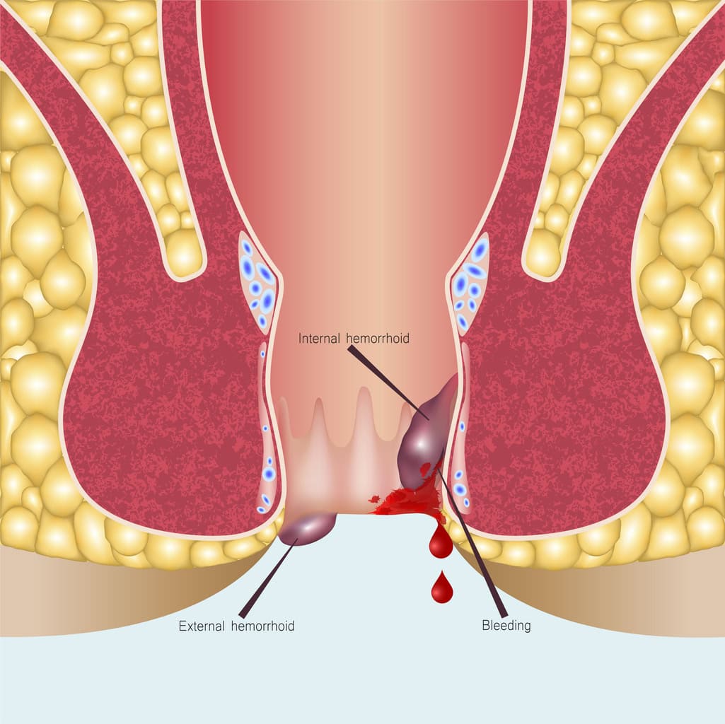 Illustration médicale des hémorroïdes internes et externes