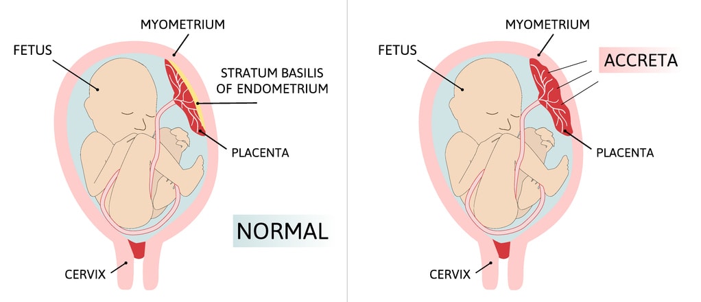 Illustration médicale du placenta accreta montrant la profondeur d'attachement