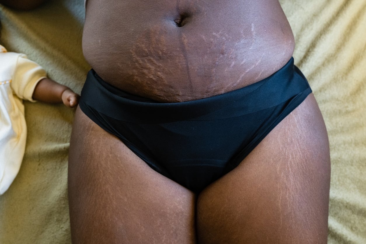 Linea nigra et vergetures
