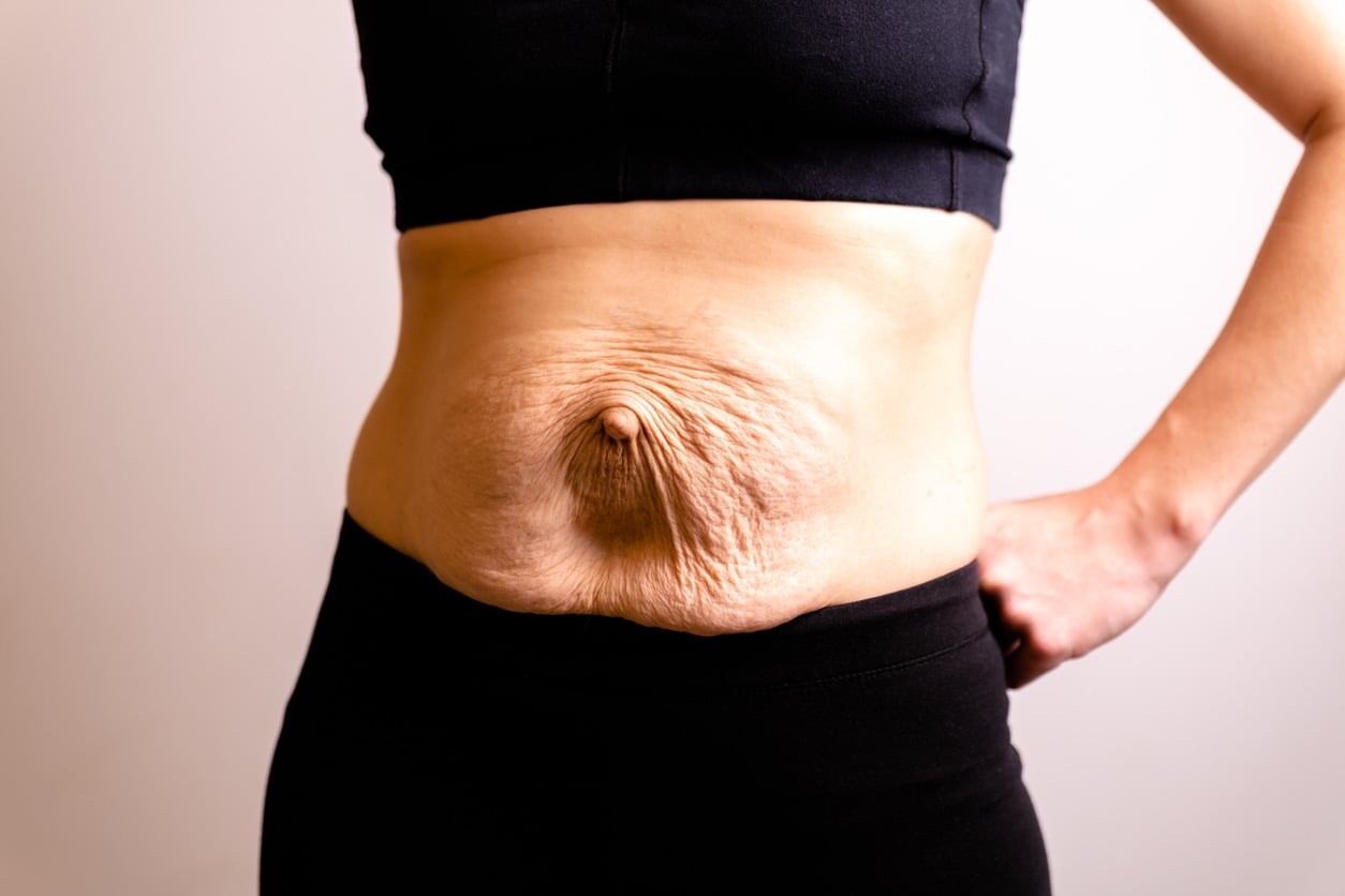 Explication visuelle du diastasis recti
