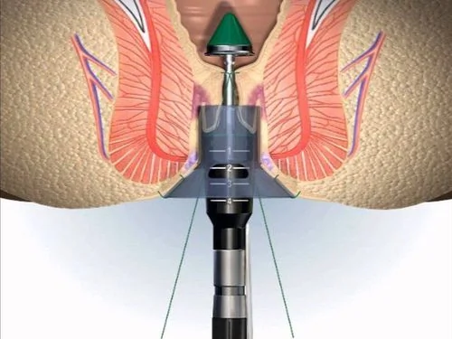 Surgical hemorrhoid reduction using the Longo method