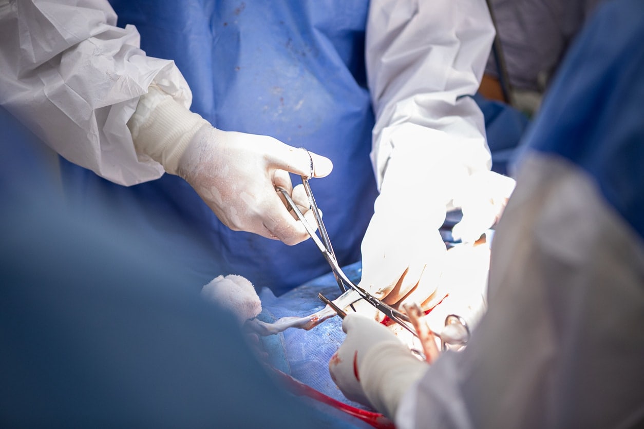 Médecins pratiquant une césarienne